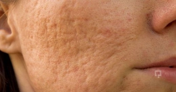 Akne Çukurları Oluşumunun Engellenmesi 