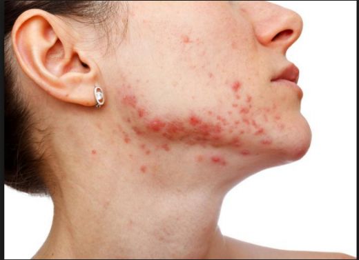 Akne Hastalığı Belirtileri ve Tedavisi