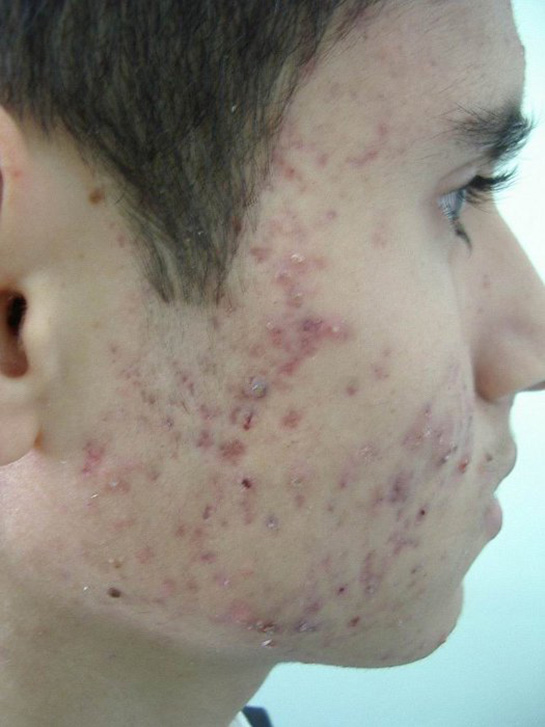 Akne Vulgaris Belirtileri ve Tedavisi